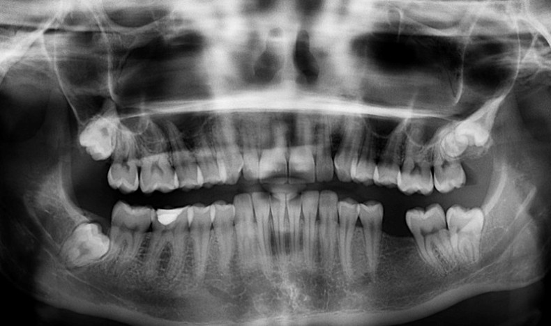 Visste du at inflammatorisk tarmsykdom kan påvirke tannhelsen din betraktelig?